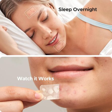 ✨ Hydrocolloid Pimple Patch Kit – 312/609 Patches, 7 Sizes for Small & Large Areas