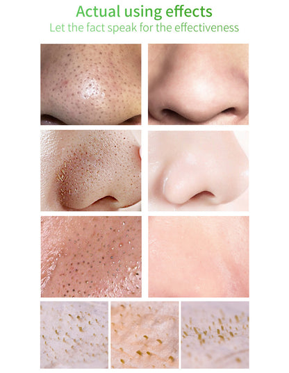 🌿 50% OFF Green Tea Blackhead Remover Kit ✨ 100 Pore Strips + Pore Care Serum