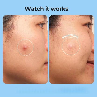 ✨ Hydrocolloid Pimple Patch Kit – 312/609 Patches, 7 Sizes for Small & Large Areas