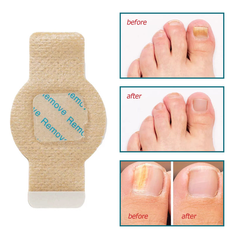 Nail Health Care Patches - Fungal Nail Treatment & Repair