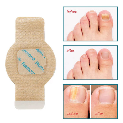 Nail Health Care Patches - Fungal Nail Treatment & Repair